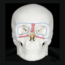 Craniofacial surgery